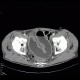 Ileocecal resection, Crohn's disease, CT enterography: CT - Computed tomography